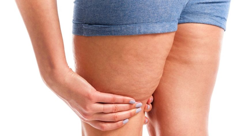 Lipedema